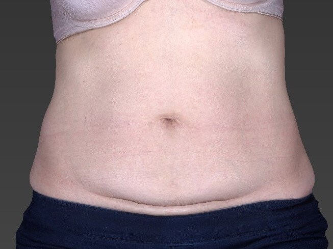Before and After Tummy Tuck Photos