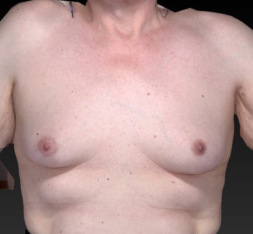 Transgender female in her 60s undergoes Breast Augmentation in